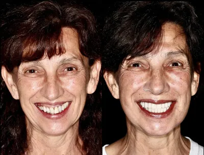Dr.DzhikaevaZarina - Гингивальная( десневая) улыбка ❓❓ Как проявляется ❓❓❓.  Причины ее появления ❓❓❓❓ И как это можно устранить ❓❓❓ Давайте  разберём,чтоб имели представление ⁉️⁉️⁉️ Десневая улыбка (Gummy Smile) –  эстетический недостаток ...