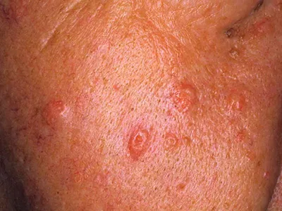 Гиперплазия сальных желез на лице лечение:сальные пробки на лице