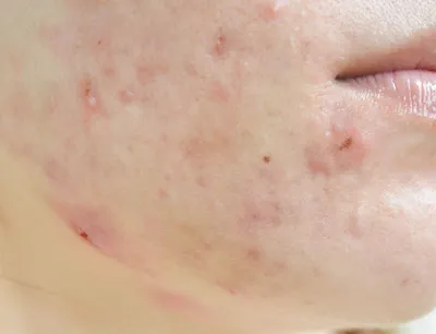 Гиперплазия сальных желез —— патология кожи, возникающая при избыточном  салоотделении. Железы растут в размерах и формируют плотные… | Instagram