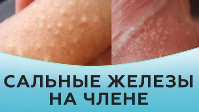 Удаление новообразований кожи на лице лазером в Санкт-Петербурге