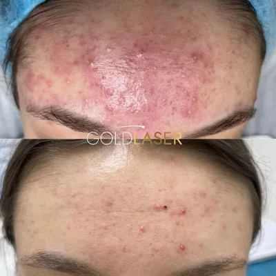 Лечение проблемной кожи » Клиника косметологии и дерматологии «ACADEMY» —  лечение кожи и волос.