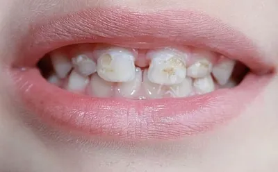 Гипоплазия зубов у детей фото фото