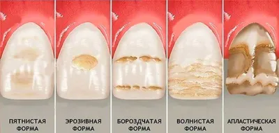 Гипоплазия эмали зубов - что это такое, виды, лечение | Новодента