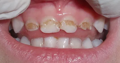 Гипоплазия эмали зубов - причины, диагностика, лечение