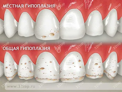 Гель стоматологический GC Tooth Mousse реминерализирующий эмаль зубов -  «Что делать, если у ребенка гипоплазия эмали молочных зубов» | отзывы