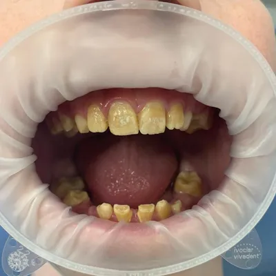 Гипоплазия зубов: причины, виды, лечение