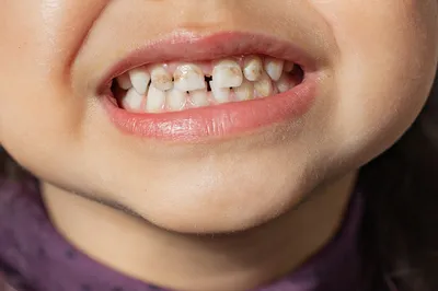 Некариозные поражения зубов у детей: причины и лечение