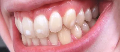 Гипоплазия эмали зубов - что это такое, виды, лечение | Новодента
