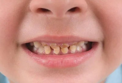 Гипоплазия эмали постоянных зубов: симптомы, причины, диагностика и лечение  у стоматолога