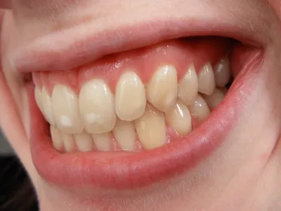 Гипоплазия эмали зубов - Семейная стоматология Дента Ареа