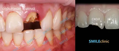 Гипоплазия зубов – симптомы и лечение — Блог стоматологической клиники  «Стомос»