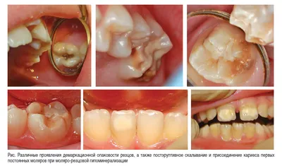 Гипоплазия, гиперплазия, флюороз, стираемость зубов, клиновидный дефект,  травма зубов и методы их лечения в Краснодаре
