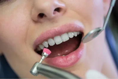 Гипоплазия эмали и кариес на жевательном зубе | Детская и семейная  стоматологическая клиника \"Белая Медведица\" | Санкт-Петербург