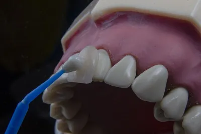 Гипоплазия эмали постоянных и молочных зубов — лечение и профилактика
