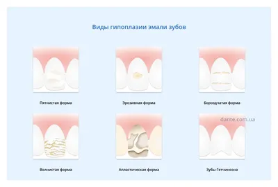 Гипоплазия (эрозия) зубов у ребенка: причины, симптомы, как лечить — D.Ante