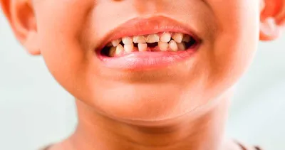 Гипоплазия эмали зубов – Стоматология «АльфаДент» в Оренбурге