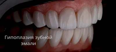 Лечение гипоплазии эмали зубов, цена от 3500 ₽ в Санкт-Петербурге