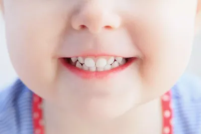 Гипоплазия эмали зубов [причины, лечение, формы и виды]