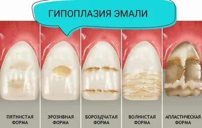 Гипоплазия эмали зубов у детей: лечение и фото | Dental Art