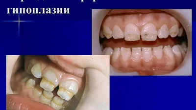 Дисплазия зубов у детей: причины, симптомы, лечение и профилактика - SHiFA