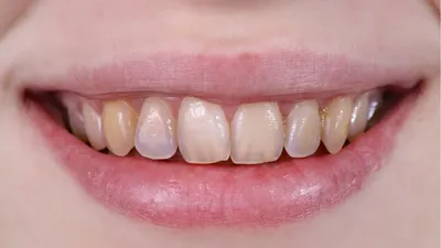 Гипоплазия (эрозия) зубов у ребенка: причины, симптомы, как лечить — D.Ante