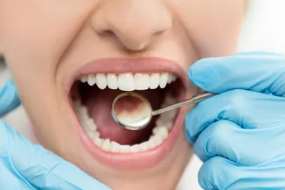 Что такое гипоплазия зубов и что с ней можно сделать?