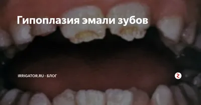 Гипоплазия эмали - Ортопедическая стоматология - «Аксиома Дентал»