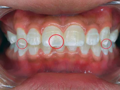 Болезни эмали зубов - лечение болезни эмали зубов: профилактика, признаки