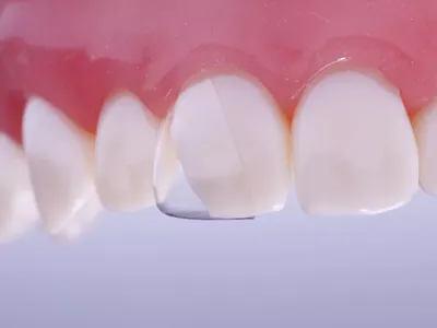 Некариозные поражения зубов: классификация до и после прорезывания