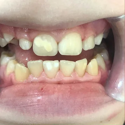 Лечение гипоплазии зубов в Новосибирске