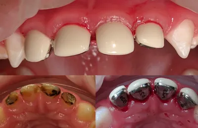 Белые пятна на зубах – почему появляются