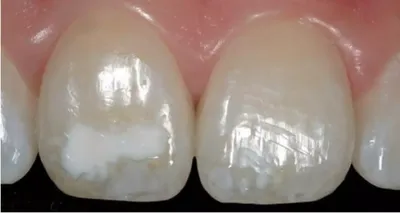 Стоматология ДенталКлаб Липецк on Instagram: \"Гипоплазия эмали 💢 Молочных  зубов Это порок развития одного или целой группы зубов, в результате  нарушения обменных процессов на том или ином временном промежутке  внутриутробного развития ребенка,