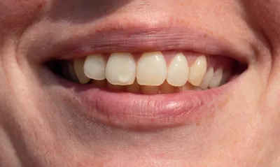 Гипоплазия эмали - Ортопедическая стоматология - «Аксиома Дентал»
