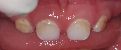Гипоплазия эмали молочных зубов — 18 ответов | форум Babyblog