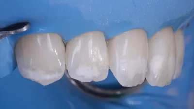 Что такое гипоплазия зубов и что с ней можно сделать?