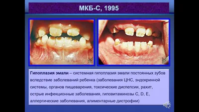 Белые пятна на зубах | возможные причины появления у взрослых - лечение и  профилактика