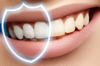 Исправление тремы или диастемы между зубами
