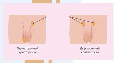 Гипоспадия у мальчиков - причины, формы, диагностика, консультация хирурга  | Москва