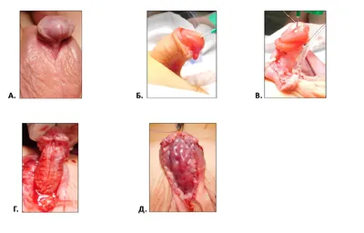 Гипоспадия | Рудин Юрий Эдвартович - Детская урология-андрология