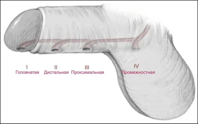 Гипоспадия | Рудин Юрий Эдвартович - Детская урология-андрология