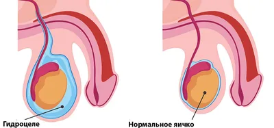 Хирургическая коррекция у пациентов с гипоспадией в Кыргызстане за 2004 -  2017 гг. – тема научной статьи по клинической медицине читайте бесплатно  текст научно-исследовательской работы в электронной библиотеке КиберЛенинка