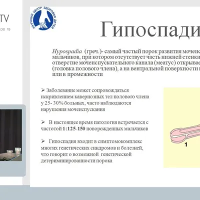 Эписпадия: причины,симптомы, диагностика, лечение