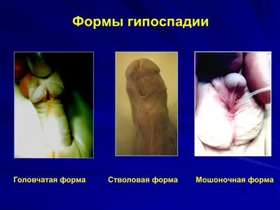 гипоспадия #детскаяурология #urology... - Moscow_urocenter | Facebook