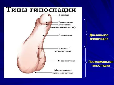 Гипоспадия: что это, симптомы, причины, диагностика, лечение