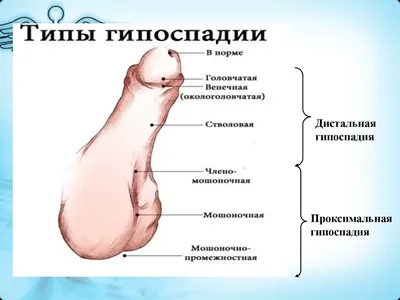 ВАРИАНТ ЛЕЧЕНИЯ ДИСТАЛЬНОЙ ФОРМЫ ГИПОСПАДИИ С ИСПОЛЬЗОВАНИЕМ ТЕХНИК