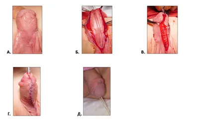 ВАРИАНТ ЛЕЧЕНИЯ ДИСТАЛЬНОЙ ФОРМЫ ГИПОСПАДИИ С ИСПОЛЬЗОВАНИЕМ ТЕХНИК