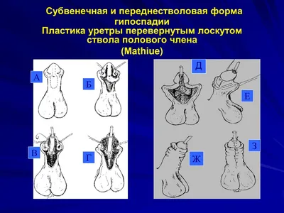 Способ хирургического лечения венечной гипоспадии — 30.10.2008 — 11121 —  База патентов Беларуси