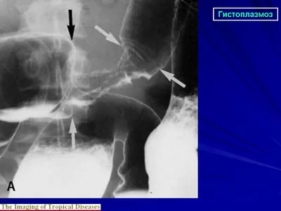 Мик. Гистоплазмоз. + | Портал радиологов
