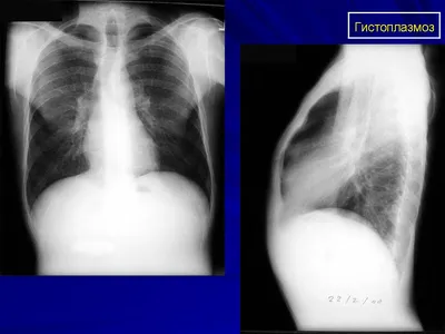Мик. Гистоплазмоз. + | Портал радиологов