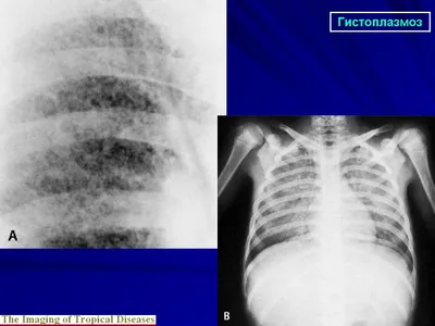 Мик. Гистоплазмоз. + | Портал радиологов
